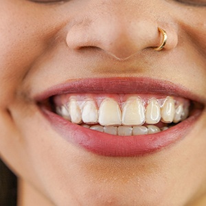 A woman putting on an Invisalign aligner