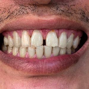Up-close view of a gap between the upper front two teeth