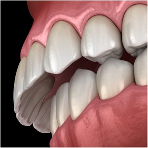 Digital view of an overbite