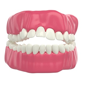 Digital image of an open bite