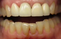 Close up of a mouth with small gaps between some teeth