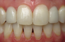 Close up of a smile with perfectly aligned teeth