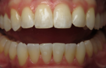 Close up of a mouth with small gaps between some teeth