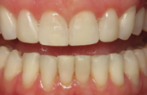 Close up of a smile with perfectly aligned teeth