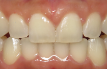 Close up of a mouth with small gaps between some teeth