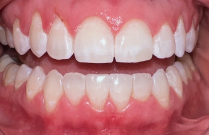 Close up of a smile with perfectly aligned teeth