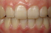 Close up of a mouth with small gaps between some teeth