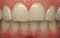 Close up of a smile with perfectly aligned teeth