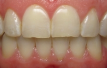 smile after veneers