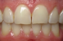 smile before veneers