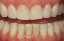 smile after veneers