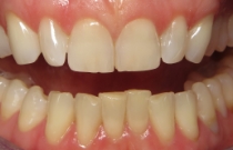 smile before veneers
