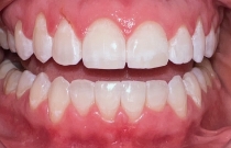 smile after veneers