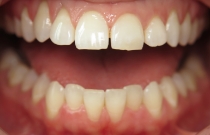 smile before veneers