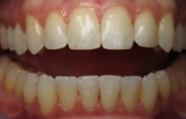 smile after veneers