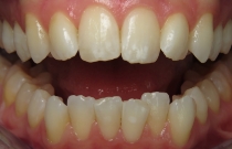 smile before veneers