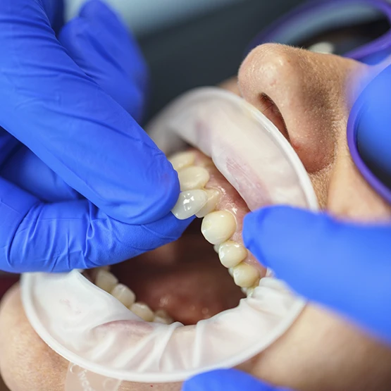 Woman getting veneers