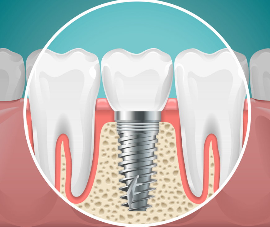 Illustration of a dental implant in cross section